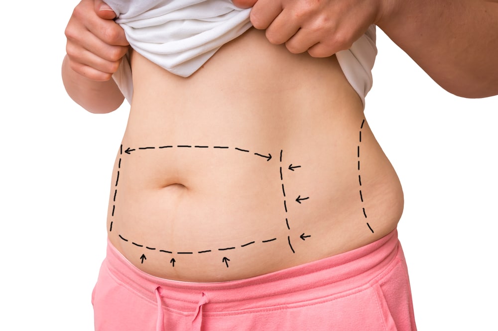 A woman is shown with lines drawn across her stomach.
